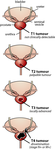 prostatecancer.gif